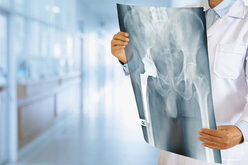 Hip Replacement Options: Finding the Perfect Implant | Medanta.jpg