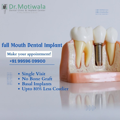full Mouth Dental Implant.jpg