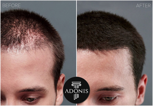 adonis toppik before after.jpg