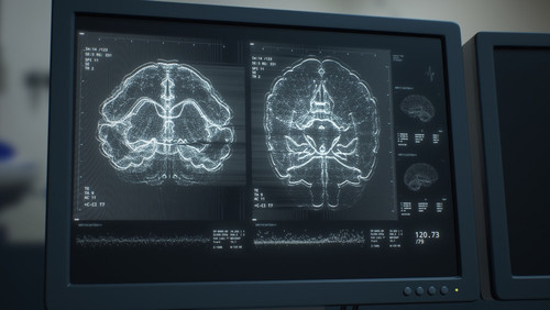 Head Tumor.jpg
