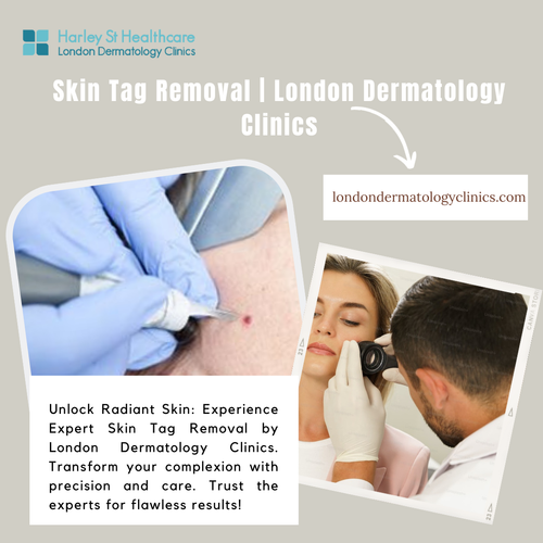 Skin Tag Removal  London Dermatology Clinics.png