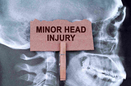 Minor Head Injury 11zon.jpg