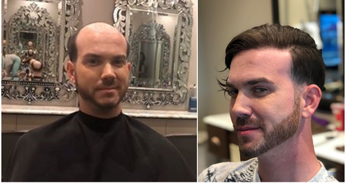 Difference between hair transplant and non-surgical hair replacement.png