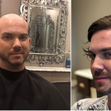 Difference between hair transplant and non-surgical hair replacement
