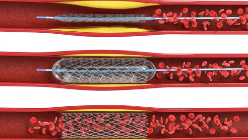angioplasty for pad.jpg
