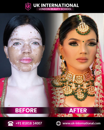 Vitiligo skin makeup At UK International.jpg