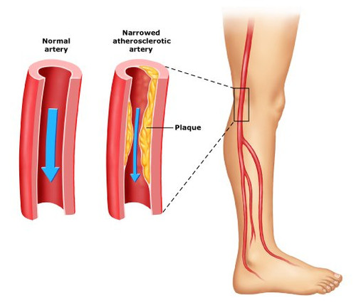 Symptoms of Claudication.jpg