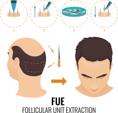 FUE Hair transplant surgery in London, UK..png