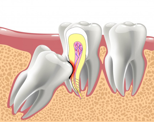 Infected Wisdom Teeth.jpg