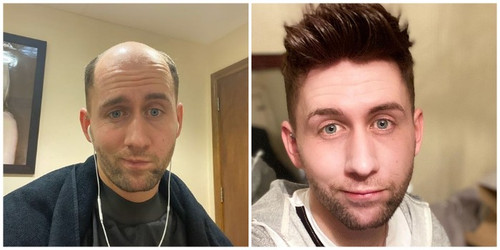the benefits of using men's wigs for hair thinning.jpg