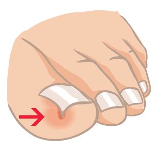 Infected Toenail Removal.jpg