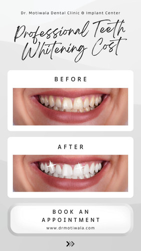 Professional Teeth Whitening Cost.jpg