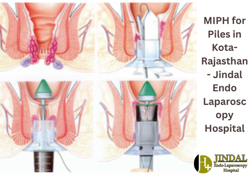 MIPH for Piles in Kota-Rajasthan - Jindal Endo Laparoscopy Hospital.png