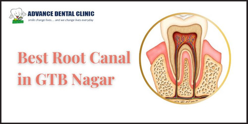 Best Root Canal in GTB Nagar.jpg