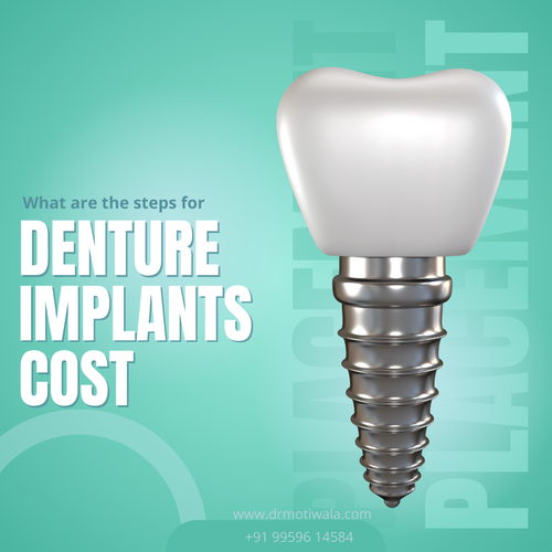 Denture Implants Cost.png