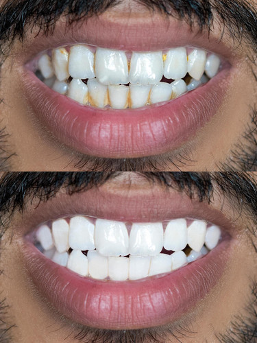 8517753 dentes antes e depois branqueamento conceito de cuidados dentarios gratis foto.jpg