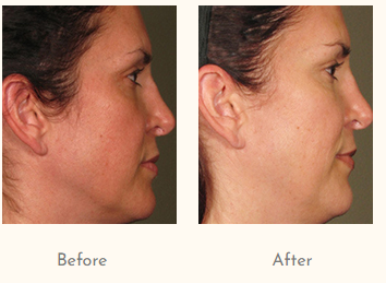 Laser Hair Reduction.png