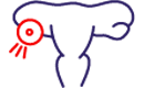 Ovarian cysts.png