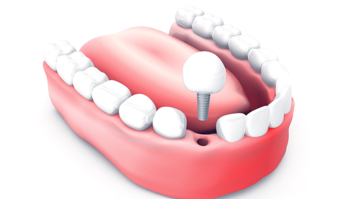 Dental implants (5).png