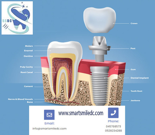 Best dental implants Dubai Copy.jpg