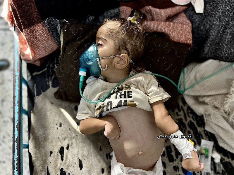 الطفلة مريم أبو مصطفى (عام و7 أشهر) تواجه الموت البطيء في غزة، حيث تعاني من سوء تغذية حاد وضمور دماغي والتهابات خطيرة، في ظل غياب الأدوية والأجهزة في ...