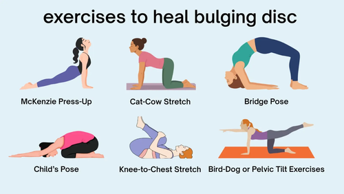 Exercises to Heal a Bulging Disc.png