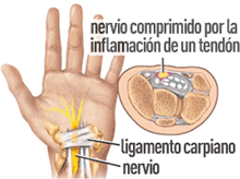 sindrome del túnel carpiano