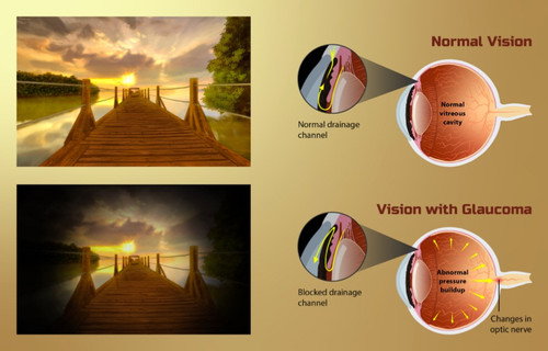 glaucoma2502.jpg