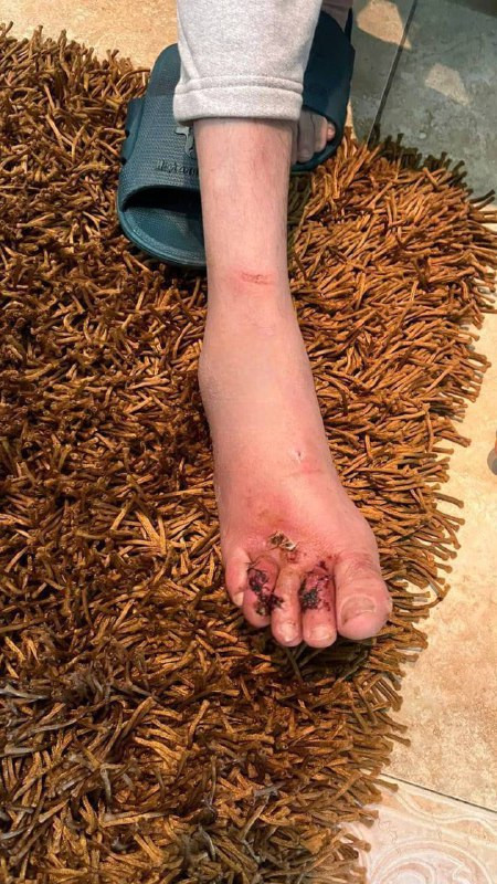 صورة | آثار الرصاصة التي أُصيب بها في قدمه الأسير المحرر خالد صباح خلال فترة اعتقاله أثناء اقتحام غرفته في السجن وإطلاق الرصاص...