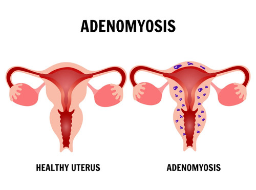 Adenomyosis Treatment in Indore.jpg