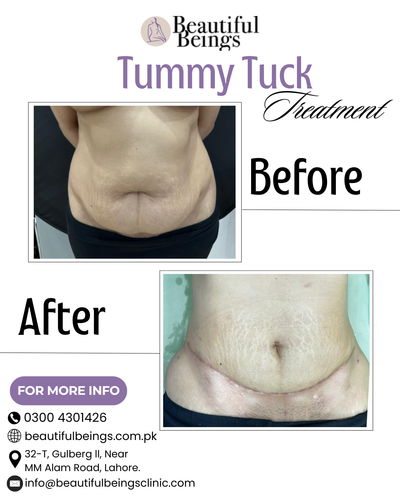 Tummy Tuck.png