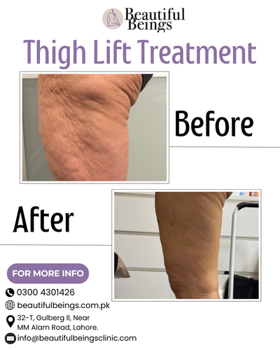 Thigh Lift Treatment.png