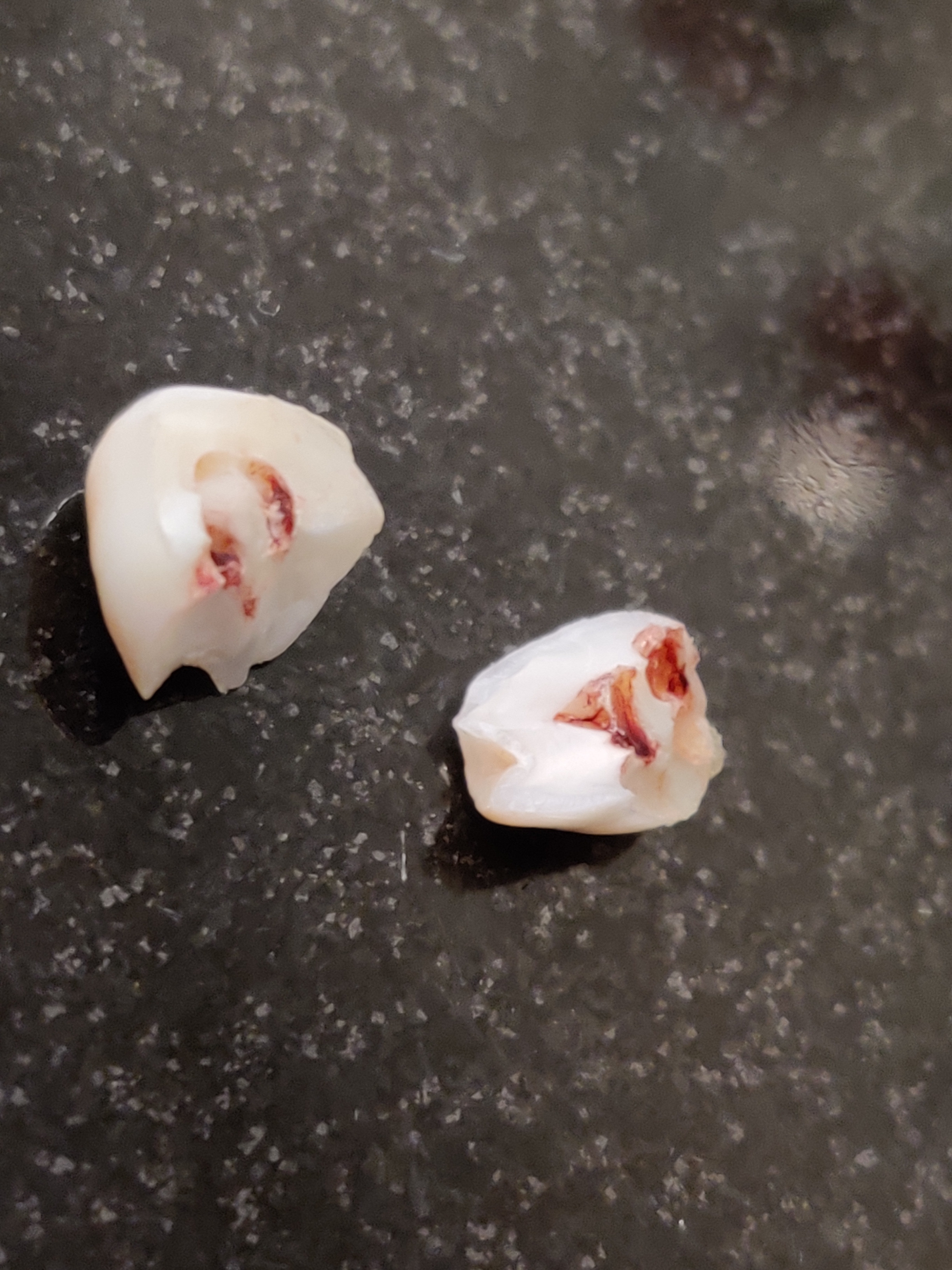 Baby Tooth Exploding On Countertop : Dentistry