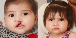 Facial Deformities Cleft Lip & Palate Surgery.jpg