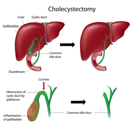 Laparoscopic Gallbladder Surgery for Gallstones.jpg