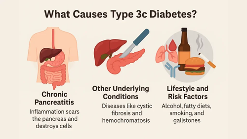What Is Type 3c Diabetes? Causes, Symptoms & Management.png