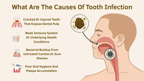 What Are The Causes Of Tooth Infection.png