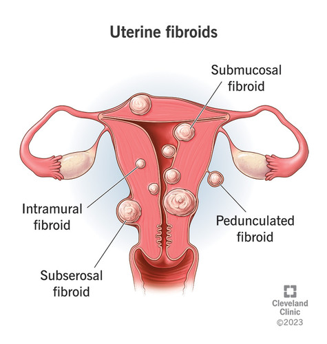 9130 uterine fibroids.jpg