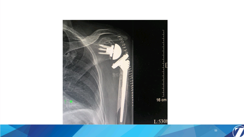 03 1 Comprehensive反肩关节置换系统(1) 20251109 1554099096917243458.png