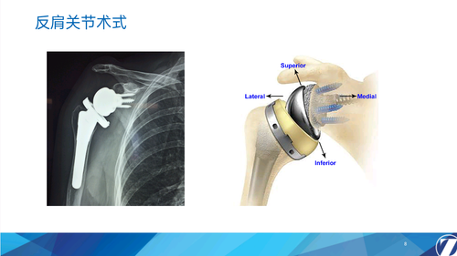 03 1 Comprehensive反肩关节置换系统(1) 20251109 8230295407092447552.png