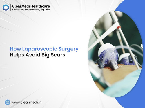 How Laparoscopic Surgery Helps Avoid Big Scars.jpg