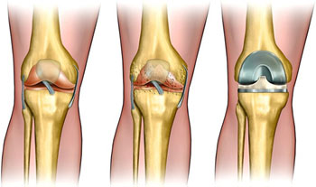 acl reconstruction.1