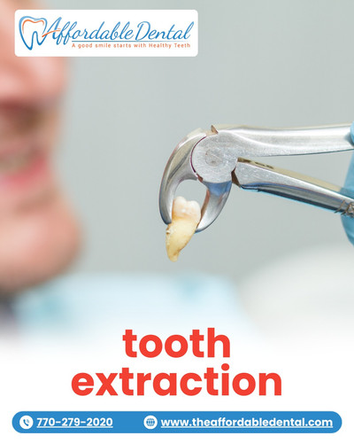 Tooth extraction near me.jpg