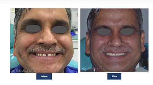 Full Mouth Restoration.png