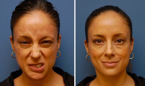 Facial Paralysis Treatment CA.jpg
