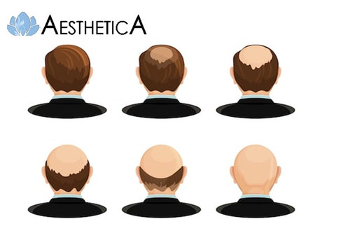 Best Hair Transplant in India.jpg