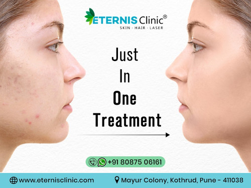 Best Acne Treatment in pune.jpg