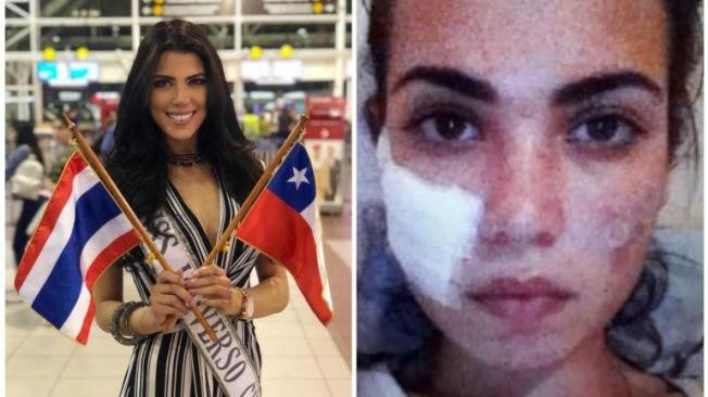Participante de Miss Universo muestra cómo cirugía arruinó su rostro VczewJ