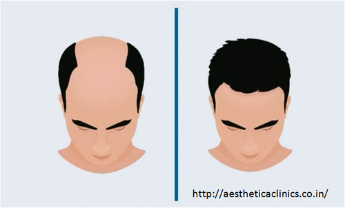 Best Hair Transplant Clinic in India.png
