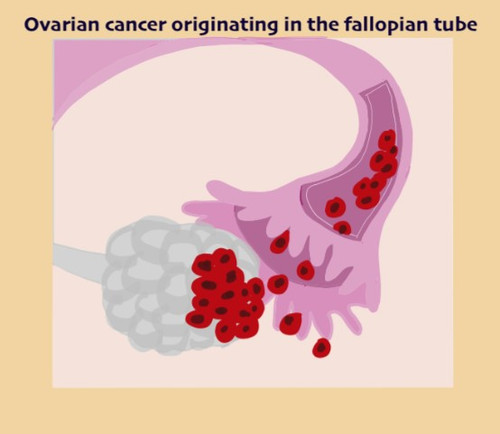 Ovarian Cancer Specialist in Ahmedabad.jpg